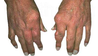 Bệnh gút triệu chứng của gout mạn tính