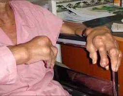 Phân biệt gút, viêm khớp, thoái hóa khớp!